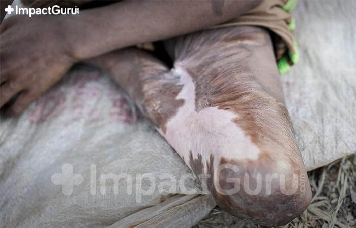 ImpactgGuru