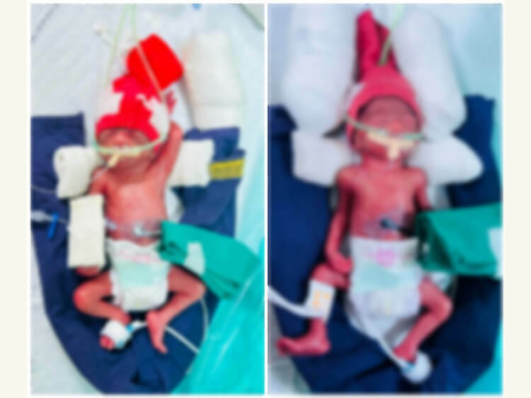 Twins Baby of Tanishka Gaonkar 