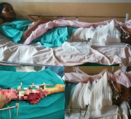 Impact Guru - Help Leelambika walk again